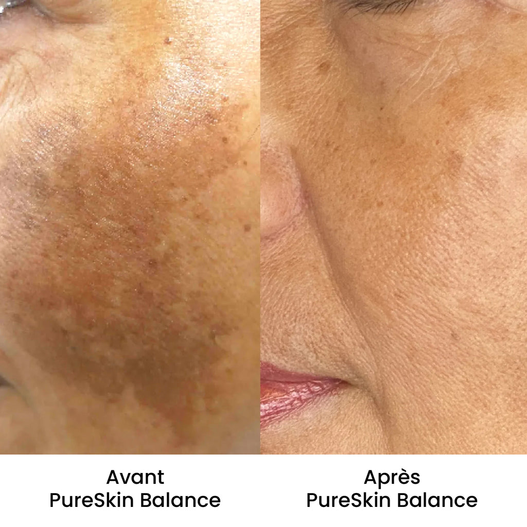 PureSkin Balance - Crème anti-taches